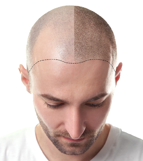 hair transplant img